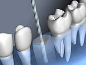 Drilling for a dental implant, illustration