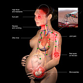 Pregnancy and zika virus, illustration
