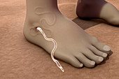 Guinea worm emerging from infected foot, illustration