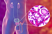 Benign prostatic hyperplasia, illustration and micrograph
