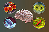 Causes of bacterial meningitis, illustration