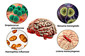 Causes of bacterial meningitis, illustration