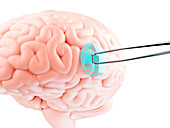 Implanting chip in human brain, illustration