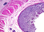 Intestinal adenoma, light micrograph