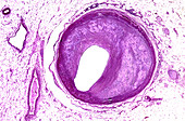 Coronary artery atherosclerosis, light micrograph