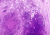 Human eosinophilic granuloma, light micrograph