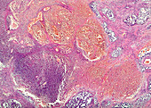 Testicular germ cell tumour, light micrograph