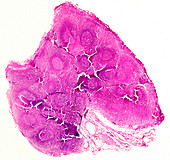Lung silicosis, light micrograph