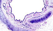 Squamous metaplasia of bronchial mucosa, light micrograph