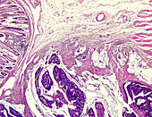 Colorectal carcinoma, light micrograph