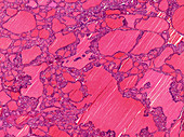 Thyroid adenoma, light micrograph