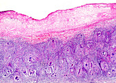 Tuberculous pleurisy, light micrograph
