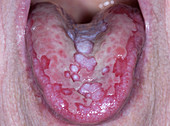 Lichen planus of the tongue