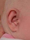 Accessory auricle ear deformity