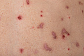 Reaction to shingles vaccine