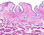 Metastatic epithelium bladder cancer, light micrograph