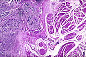 Transitional cell cancer of the bladder, light micrograph