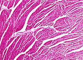 Rheumatic myocarditis, light micrograph