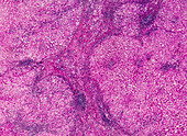 Focal nodular hyperplasia, light micrograph