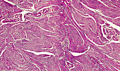 Uterine adenomyosis, light micrograph