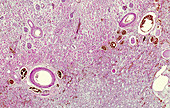 Acute nephritis, light micrograph