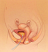 Catheter in full bladder, illustration