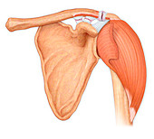 Torn shoulder ligaments, illustration