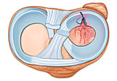 Fractured tibia bone and torn meniscus, illustration