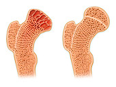Normal versus arthritic thigh bone, illustration