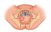Forceps delivery, illustration
