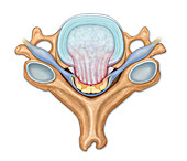 Herniated disk, illustration