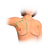 Stage three breast cancer, illustration
