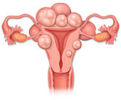 Uterine fibroids, illustration