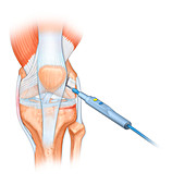 Knee surgery, illustration