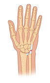 Wrist injury, illustration