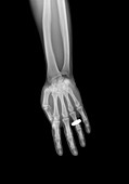 Hand with jewellery, X-ray