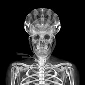Skull and helmet, X-ray