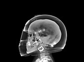 Skull and helmet, X-ray