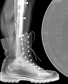 Broken leg, X-ray