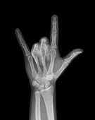 Rock on skeleton hand, X-ray