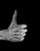 Thumbs up hands gesture, X-ray