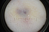 Dermatofibroma, dermatoscope image