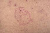 Pityriasis lichenoides chronica