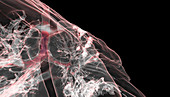 Lungs affected by Covid-19, 3D CT scan