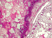 Human acute caseous pneumonia TB, light micrograph