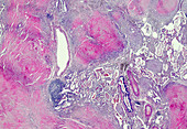 Pneumoconiosis lung disease, light micrograph