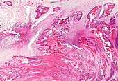 Comedo carcinoma of the breast, light micrograph