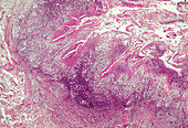Chronic tuberculosis epididymitis, light micrograph