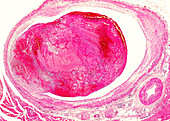 Vein-organising thrombosis, light micrograph
