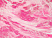 Myocardial fibrosis, light micrograph